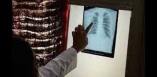 New TB Research Could Revolutionize Treatment for Inflammatory Disorders